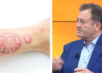 Ylli Merja, Psoriaza