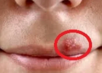 3 metoda që zhdukin herpesin në buzë brenda ditës